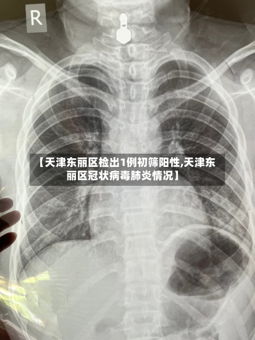 【天津东丽区检出1例初筛阳性,天津东丽区冠状病毒肺炎情况】-第3张图片